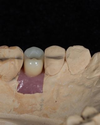 Implante de cimento de parafuso para implantes dentários de longa duração com garantia de 5 anos