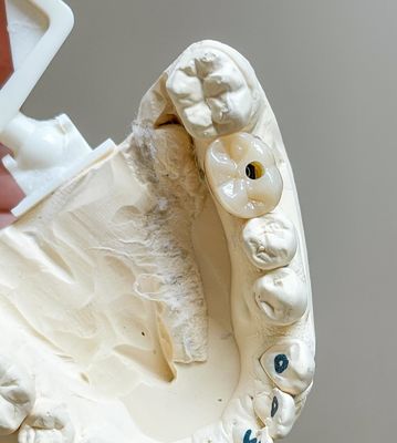 Cimento de parafuso Implante retido Implantes polidos Ponte de porcelana suportada Arco completo