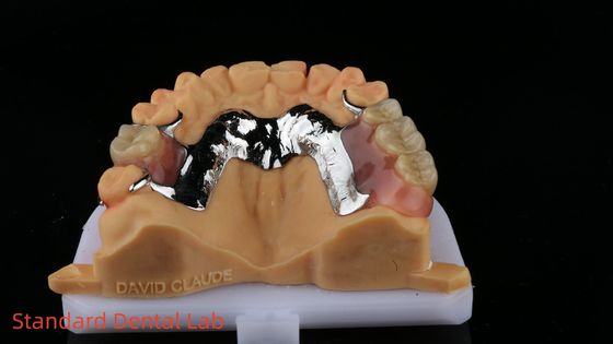 CorCr Metal Parcial Dentura Alta Luz Berílio Livre Ivoclar Scheftner Confortável Metal Framewrok
