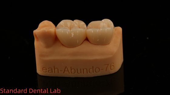 Coroas de laboratório dentário sólido 3D Pro de alta translucidez Coroas de zircônio completo com 5 anos de garantia