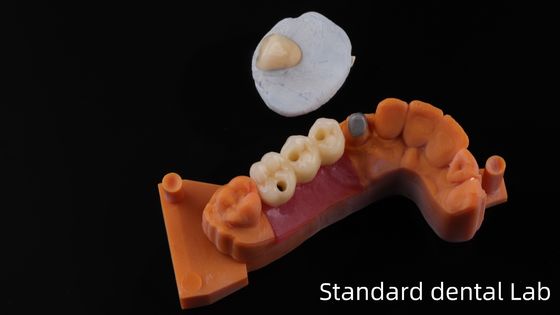 Post Core Dental Lab da China / Metal Post Core com PFM Crown
