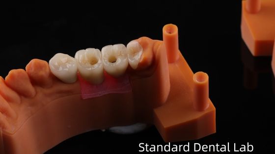 Coroa de Implante Dental Retido por Parafuso com PFZ Porcelana em camadas de Zirconia Garantia de 5 anos e Modelo de Impressão 3D