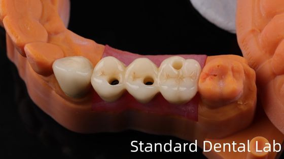 Implante dentário de zircônio profissional Coroa de titânio CAD CAM Coroa de zircônio Laboratório dentário da China