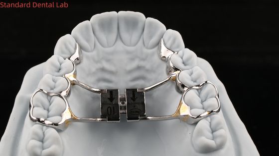 Arco Dentes Palato Expander Estável Hyrax Palatal Expander Perfeito Ajuste SDL Dental Laboratório de Ortodontia Appliance