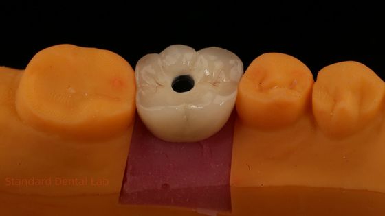 Coroa de Implante Dental de Zircônia de Porcelana PFZ Retida por Parafuso do Laboratório Dental ISO FDA CE Certificada com Garantia de 5 Anos