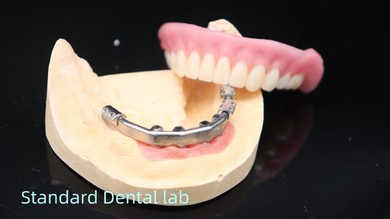 Dentaduras de apoio de implantes de titânio Dentaduras de precisão Ivoclar sobre implantes