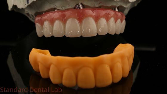 Garantia de 5 anos Implante Dental Coroa PMMA Ponte Sobre Abutments Multi Unidade Personalizado Vita Shade