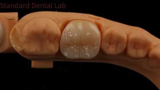 Dental Digital Full Zirconia Crown com Noritake Porcelana Impressão 3D Modelo 5 anos de garantia