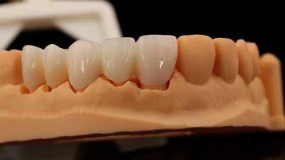 Dentes Anteriores de Alta Estética de Conto Completo Coroa de Zircônio com Laboratório Dental Vita Shade Personalizado