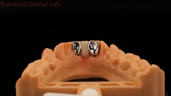 Dental PFM Maryland Bridge Alta Estética FDA Certificado com Vita Porcelan China Dental Lab
