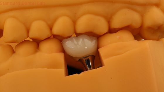 Coroa de Implante Dental Retido por Parafuso Coroa Dental PFM Com Modelo de Impressão 3D