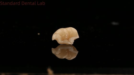 Força Emax Coroa Cerâmica Dental Onlay com Excelente Resistência a Manchas China Dental Lab
