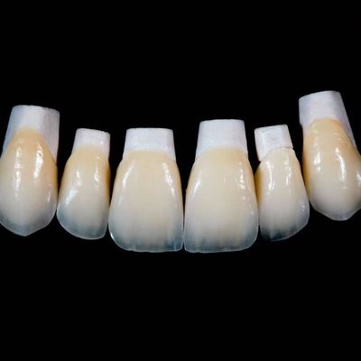 Coroa de veneers de porcelana Emax de alta translucidez com melhores materiais por Ivoclar Vivadent