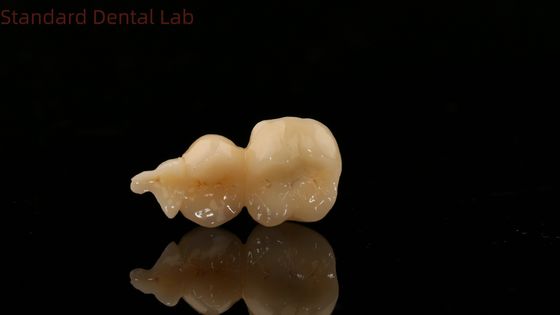Dental Digital Full Zirconia Crown com Impressão 3D Modelo SDL Dental Lab Zirconia Onlay