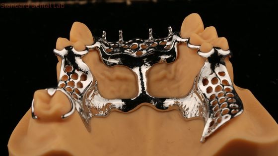 Quadro superior fundido Dentes parciais de metal acrílico Forte leve e durável