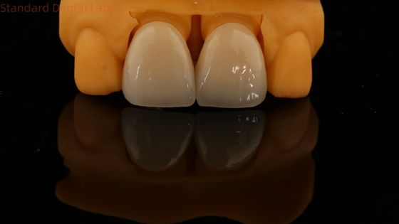 Garantia de 5 anos Conto completo Coroa de zircônio personalizada Sombra Vita Alta Estética Ponte Dental Natural