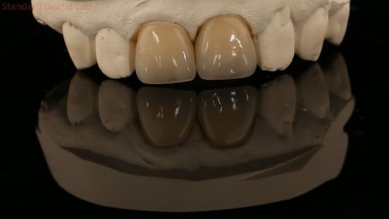 Coroa de zircônio de contorno completo e ponte dentária natural de alta estética 5 anos de garantia