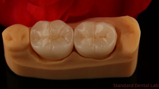 Coroa de contorno completo de zircônio Força e estética excepcionais Sem revestimento de porcelana Coroa posterior China Laboratório dentário