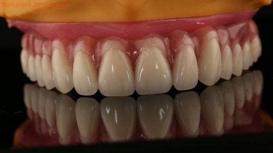 Implante parcial de acrílico sobre dentadura de titânio barra dentadura completa Dentes montados para o parafuso retido