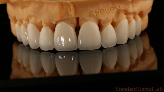 Coroas de laboratório dentário de contorno completo de alta translucidez