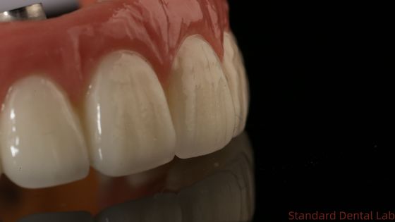 Implante dentário de zircônio profissional Coroa de titânio CAD CAM Coroa de zircônio Laboratório dentário da China