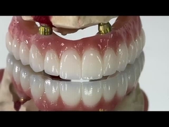 Dentário All On X Implante PFM Corona Titânio Fixado Dentadura Híbrida