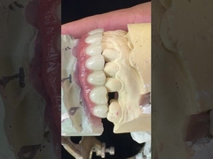 Dentaduras de apoio de implantes de titânio Dentaduras de precisão Ivoclar sobre implantes
